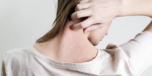 Eruption cutanee : comment distinguer allergie et urticaire ?