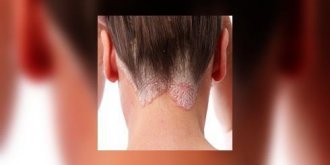 Psoriasis, et si on en parlait ?