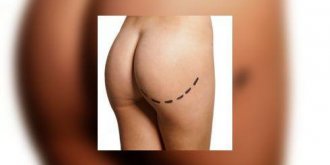 La liposuccion : qui, quoi et comment ? 