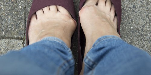 Hallux valgus : peut-on se debarrasser d-un oignon au pied ?