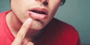 Herpes : prevenir le bouton de fievre, c-est possible !