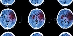 Accident vasculaire cerebral : qu-est-ce qu-un AVC ischemique ?