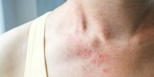 Eczema allergique : les symptomes