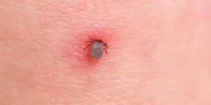 Maladie de Lyme : que faire en cas de morsure de tique ?