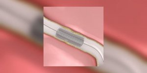 Angioplastie, stent : comment sauvent-ils nos arteres ?