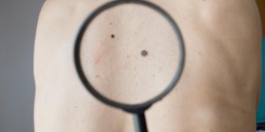 Le cancer de la peau est-il foudroyant ?