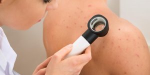 Acne : les causes qu-on ignore trop souvent