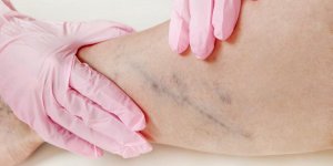 Operation des varices : quand, comment, pourquoi ?