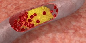 Atherosclerose : la maladie qui touche les 40-54 ans