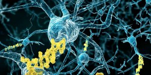 Alzheimer : un deremboursement des medicaments conteste par les medecins