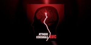 AVC : les symptomes d’alerte a connaitre