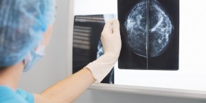 Cancer du sein metastase : mieux vaudrait eviter le palbociclib (Ibrance®)