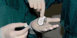 "Implant Files" : les dispositifs medicaux au cœur d’un scandale