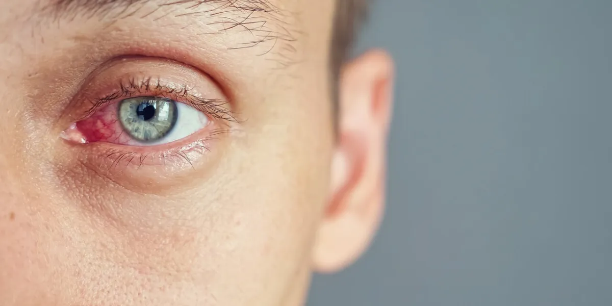 close up of the red eye of a man affected by an infection, copy space close up of the red eye of a man affected by an infection, copy space