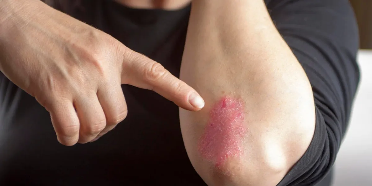 psoriasis sur le coude psoriasis sur le coude