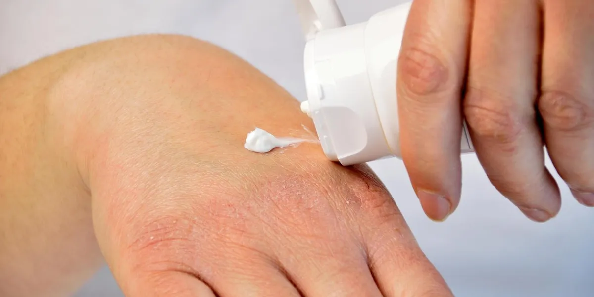 cropped image of a young woman putting moisturizer onto her hand with very dry skin and deep cracks with cream cropped image of a young woman putting moisturizer onto her hand with very dry skin and deep cracks with cream
